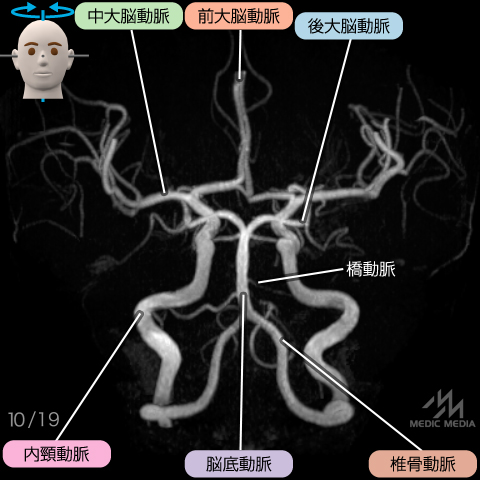 Mra 病気がみえるvol 7 脳 神経