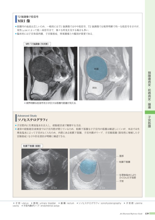 第29回 109I58 子宮筋腫① | 現役産婦人科医による医師国家試験