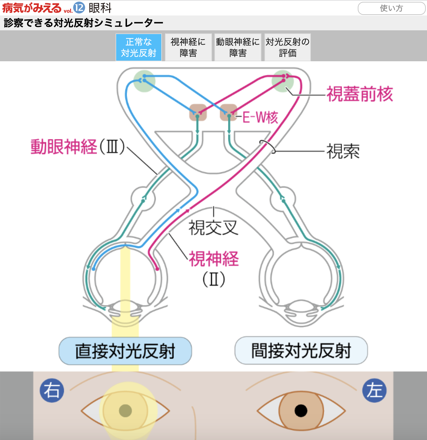 【病気がみえるvol.12 眼科】診察できる対光反射シミュレーターが誕生！